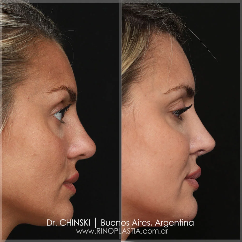Antes e depois de rinoplastia – caso 67