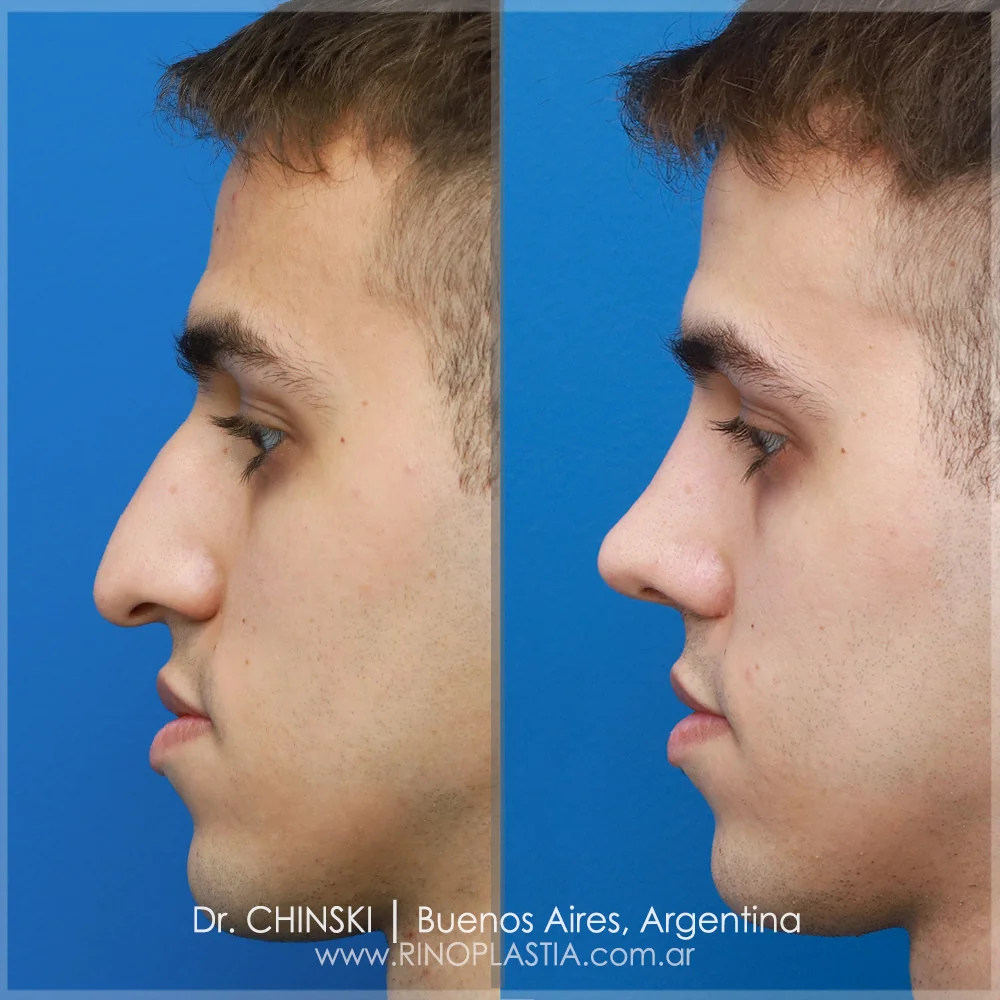 Antes e depois de rinoplastia – caso 68