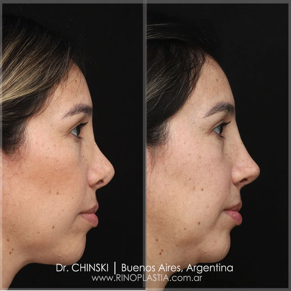 Rhinoplasty before and after – case 69
