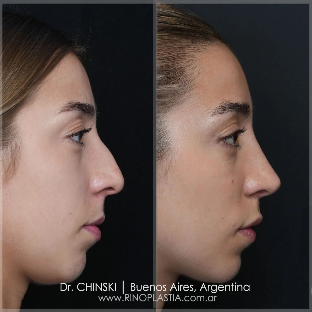 Antes y después de rinoplastia – caso 7