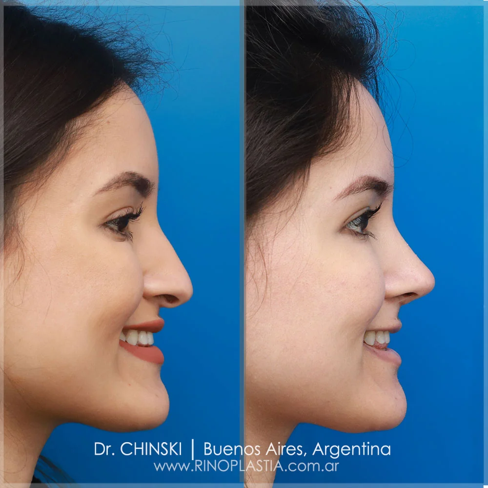 Antes e depois de rinoplastia – caso 70