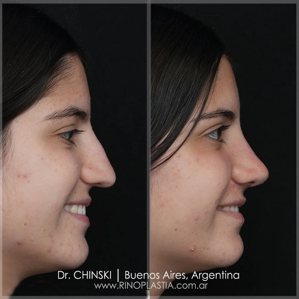Antes e depois de rinoplastia – caso 72