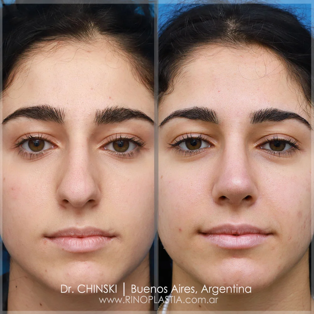 Antes e depois de rinoplastia – caso 73