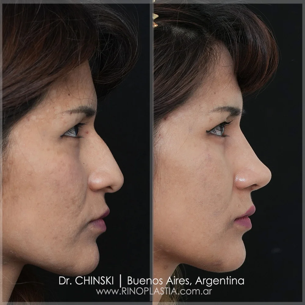 Antes e depois de rinoplastia – caso 74