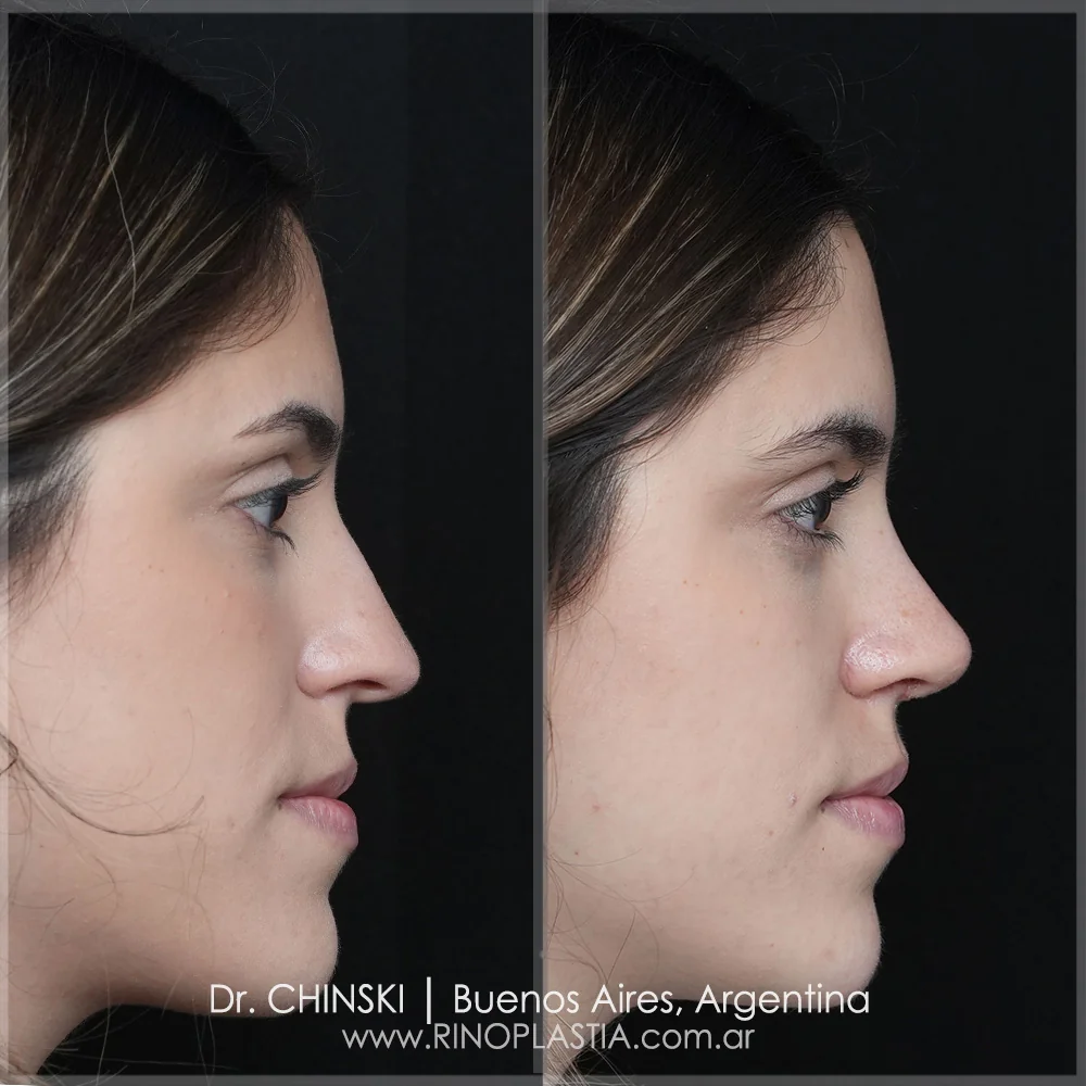 Antes e depois de rinoplastia – caso 76