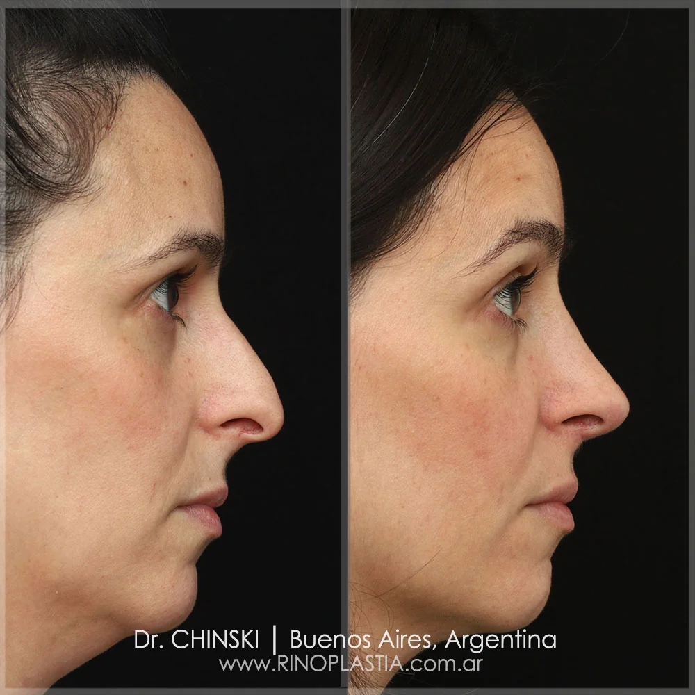 Antes e depois de rinoplastia – caso 77