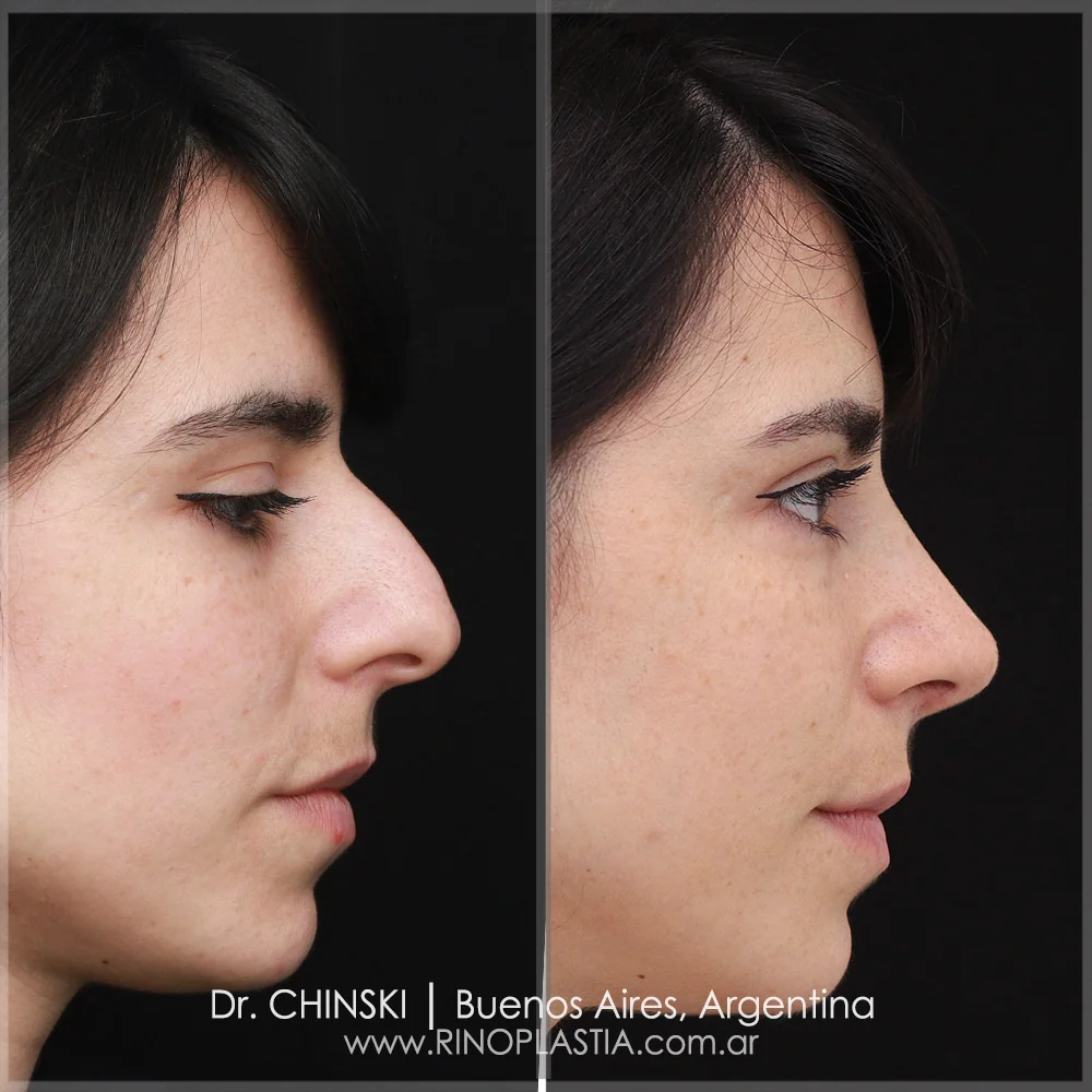Antes e depois de rinoplastia – caso 78