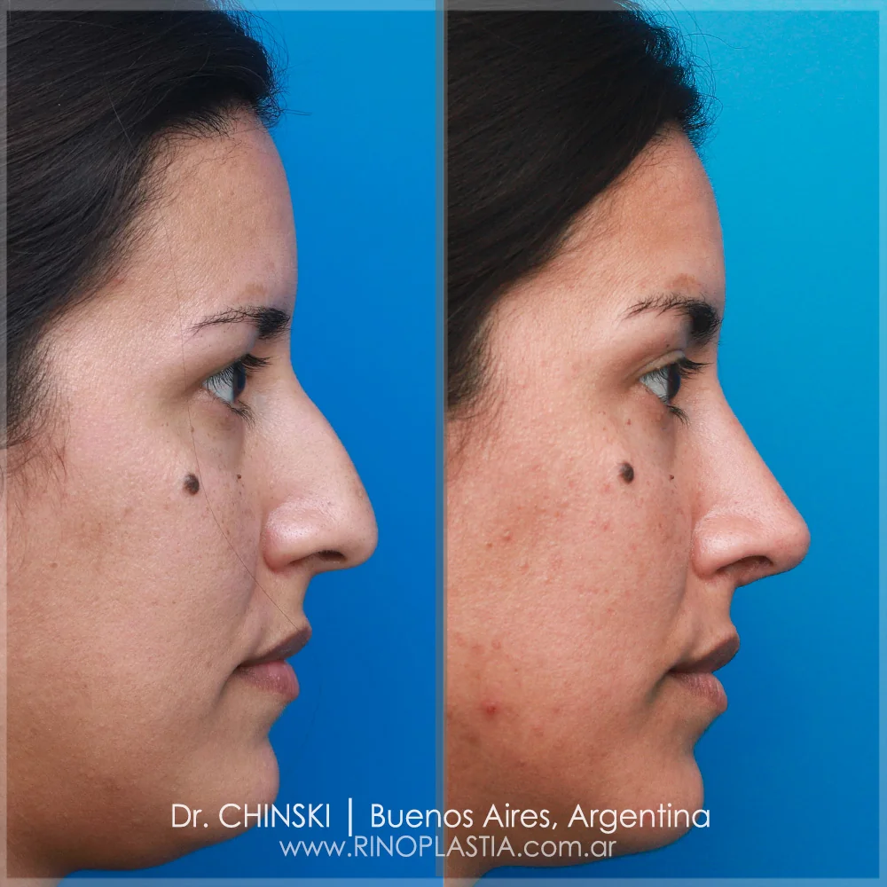 Antes e depois de rinoplastia – caso 79