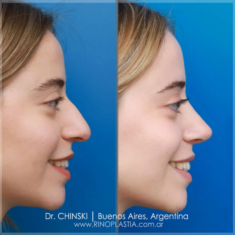 Antes e depois de rinoplastia – caso 80