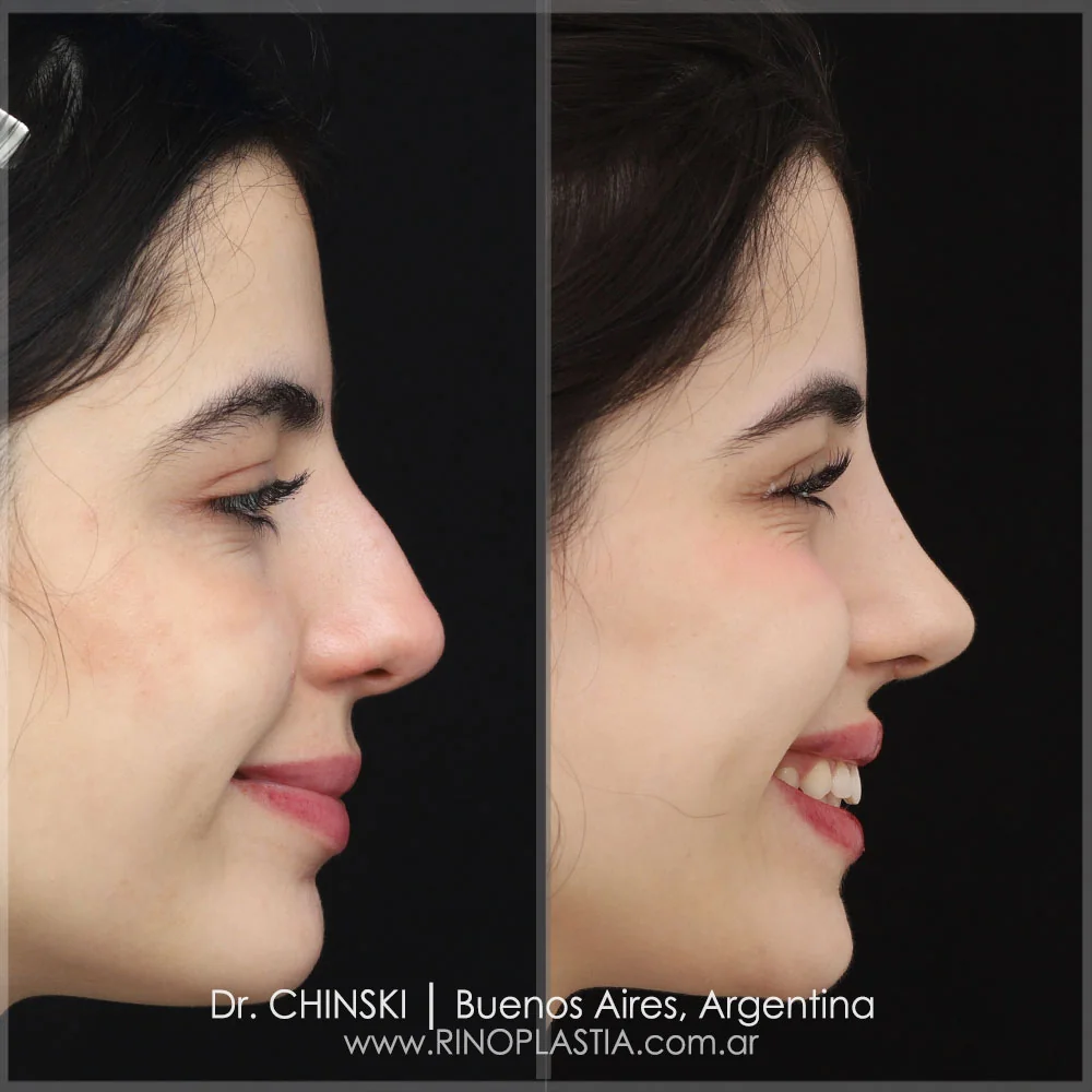 Antes e depois de rinoplastia – caso 81