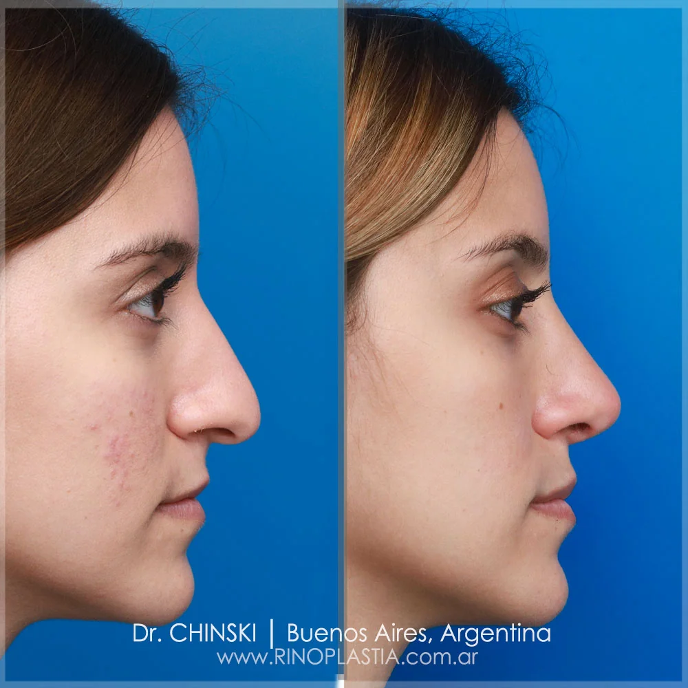Antes e depois de rinoplastia – caso 82