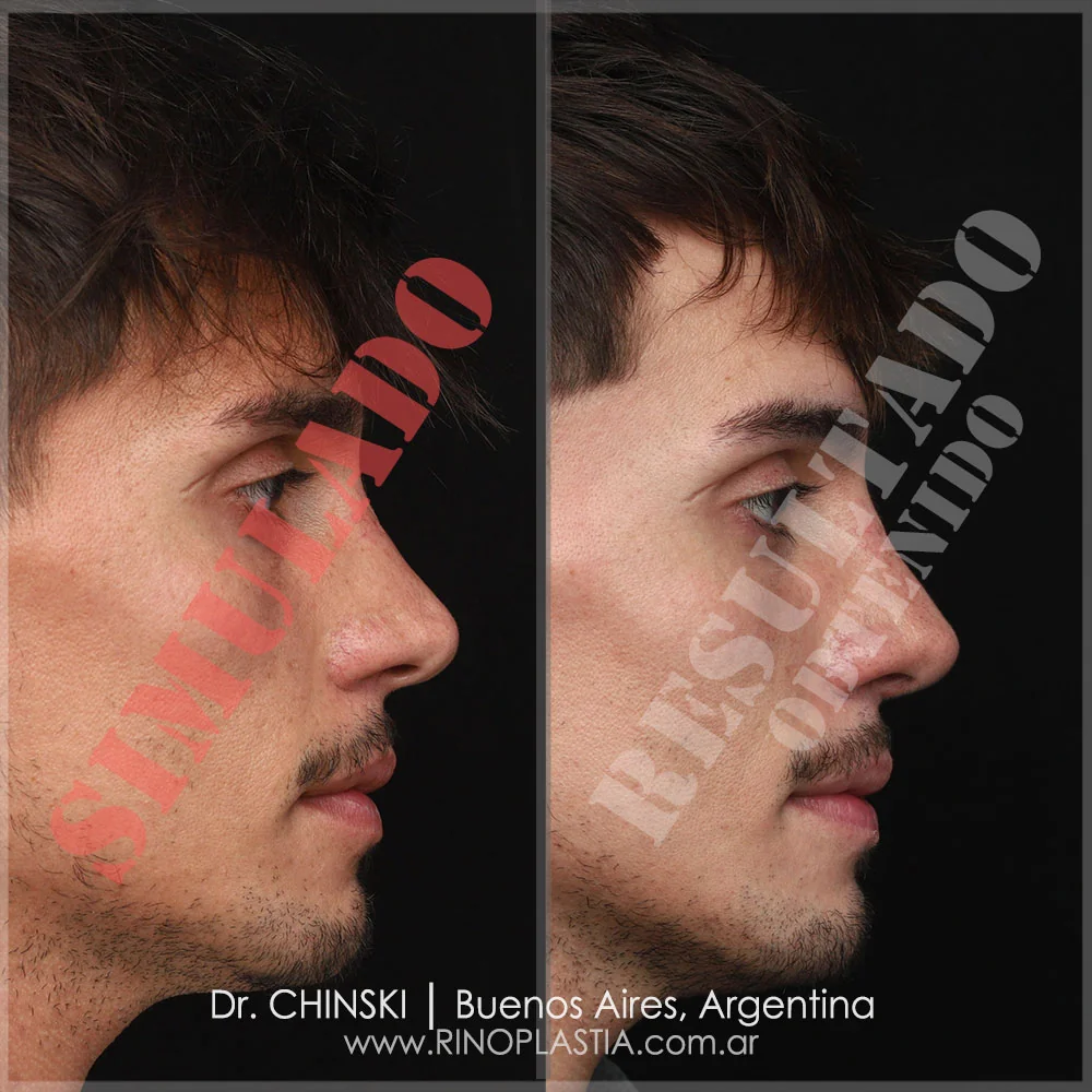 Rhinoplasty before and after – case 83
