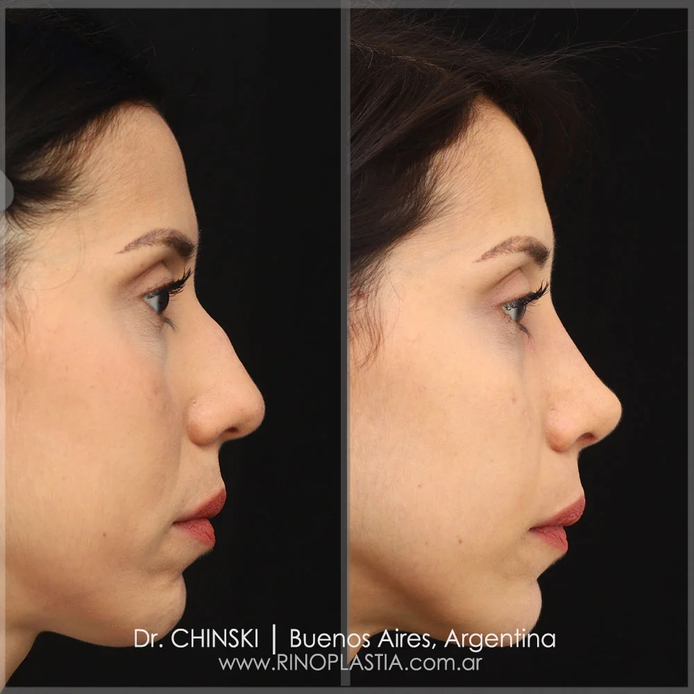 Antes e depois de rinoplastia – caso 84