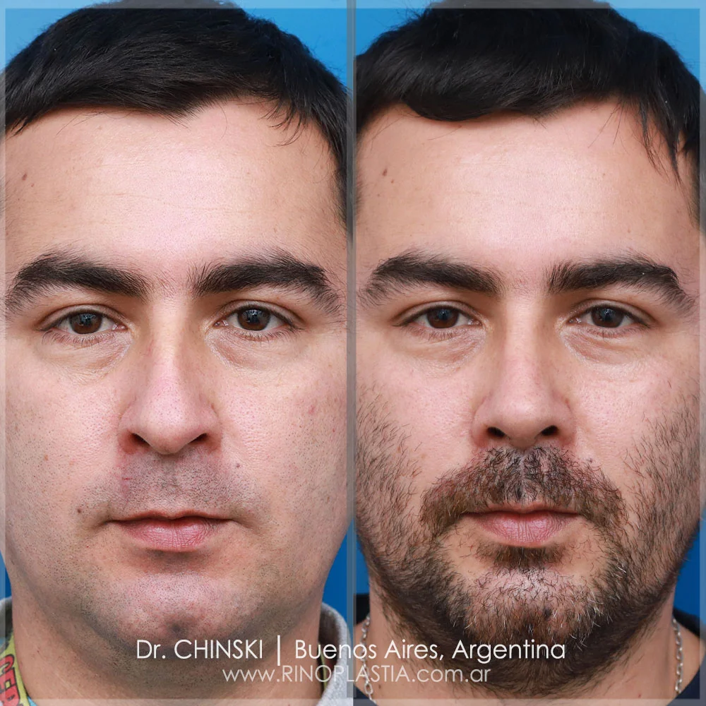 Antes e depois de rinoplastia – caso 86