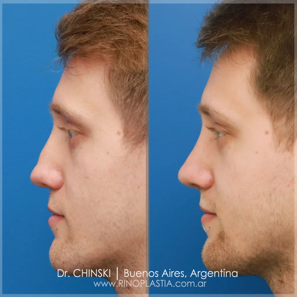 Rhinoplasty before and after – case 87