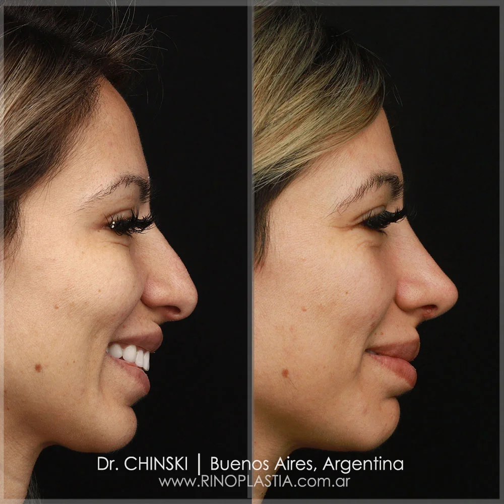 Antes e depois de rinoplastia – caso 88