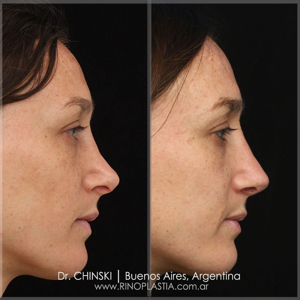 Rhinoplasty before and after – case 89
