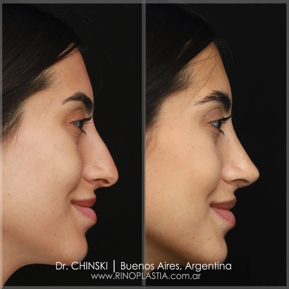 Antes y después de rinoplastia – caso 9