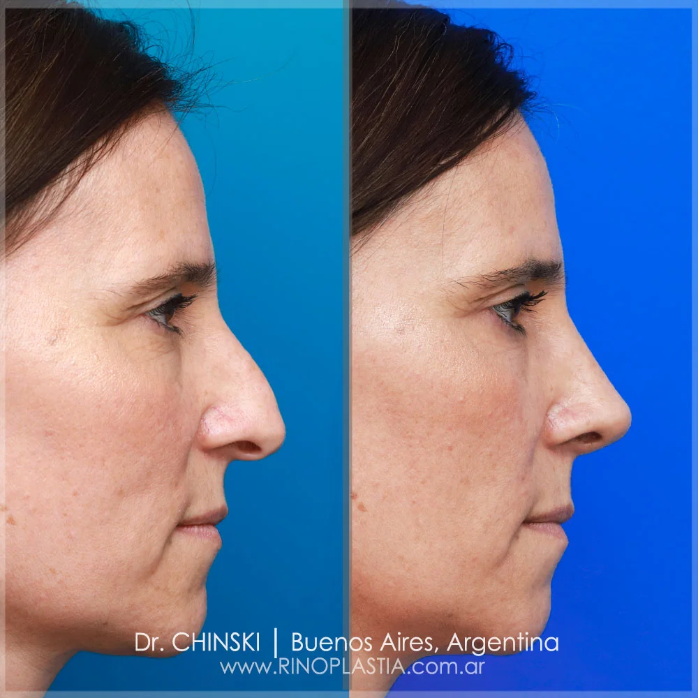 Antes e depois de rinoplastia – caso 90