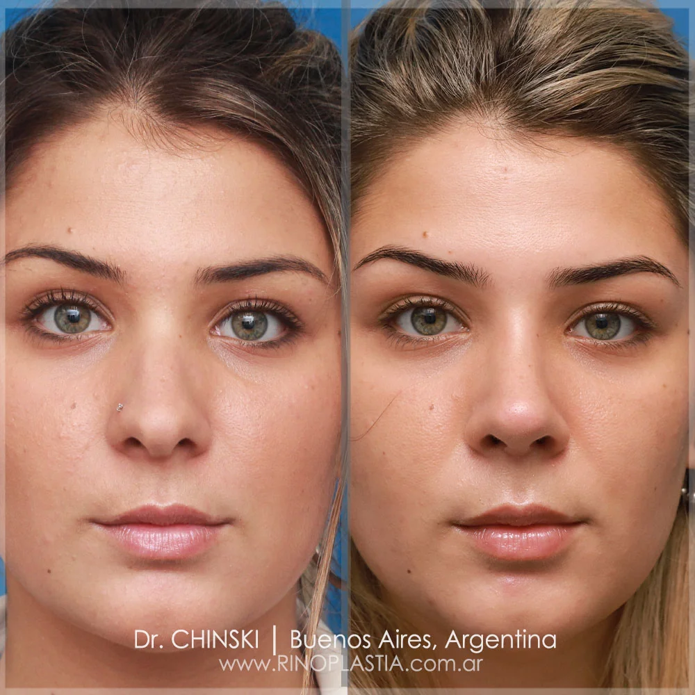 Antes e depois de rinoplastia – caso 91