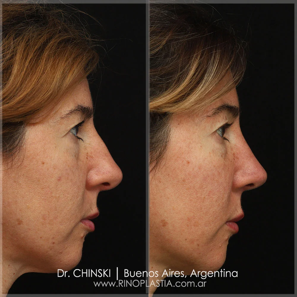 Antes e depois de rinoplastia – caso 92
