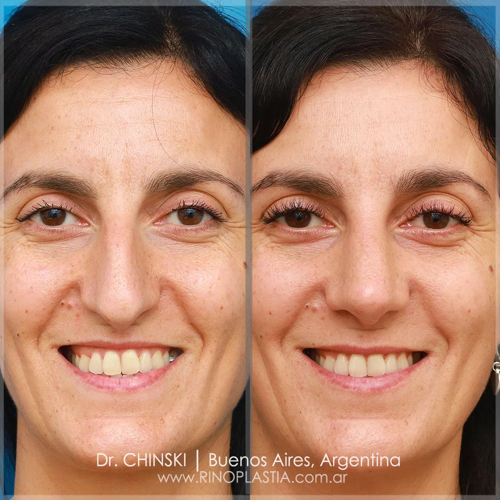 Antes e depois de rinoplastia – caso 93
