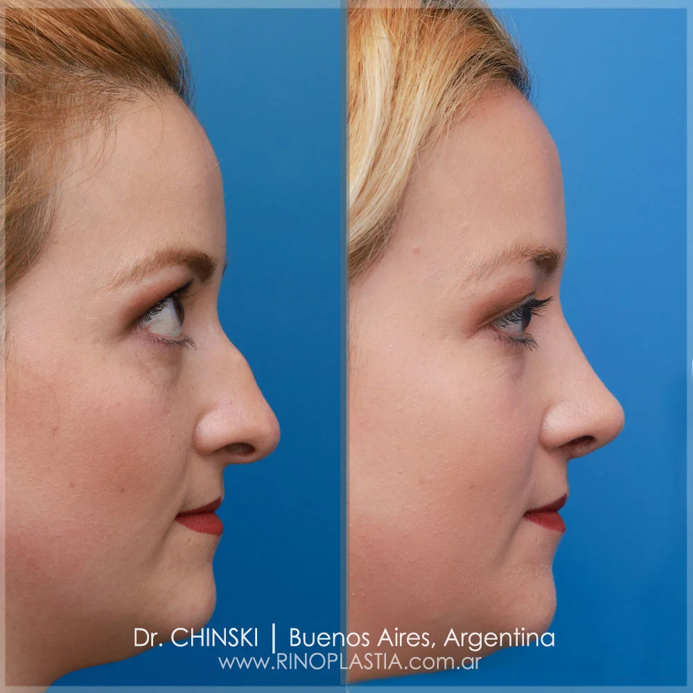Antes e depois de rinoplastia – caso 94