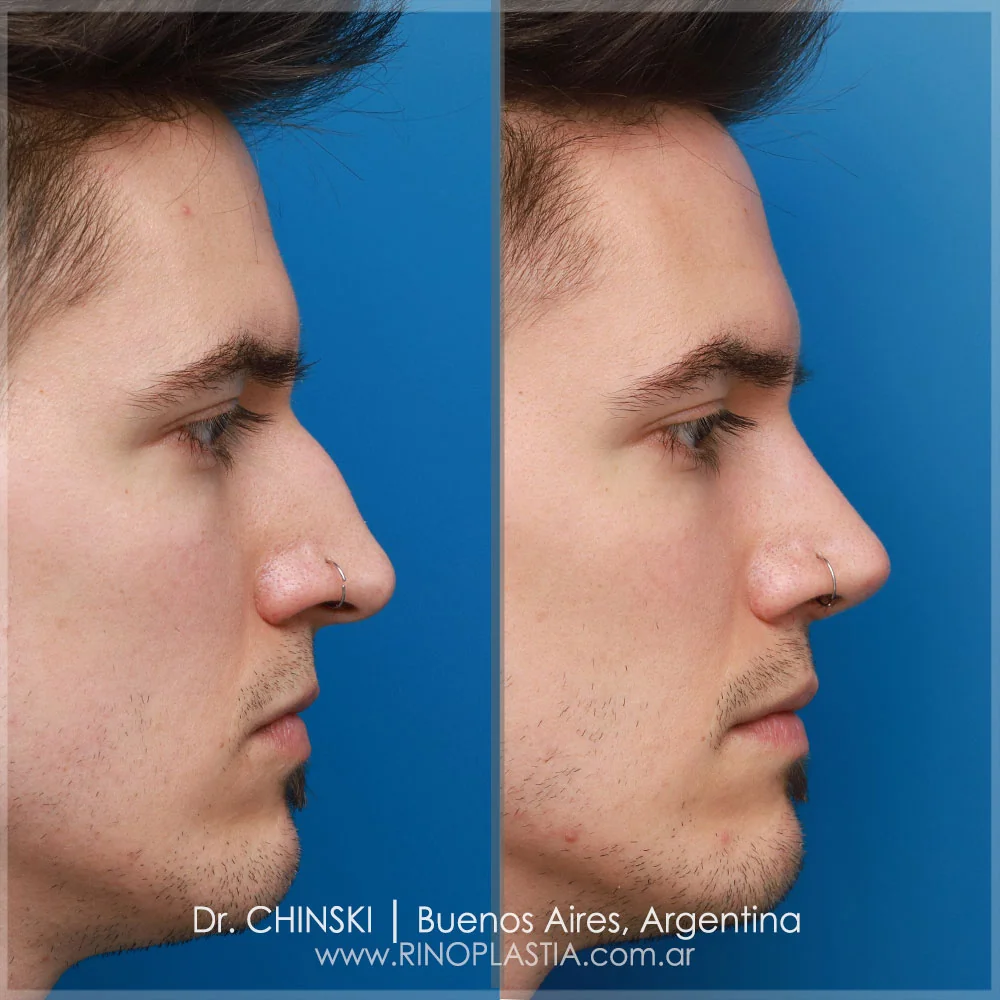 Antes e depois de rinoplastia – caso 95