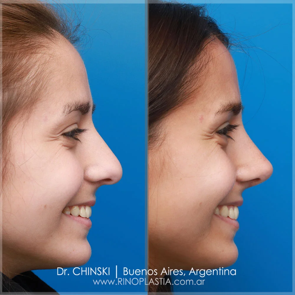 Antes e depois de rinoplastia – caso 96
