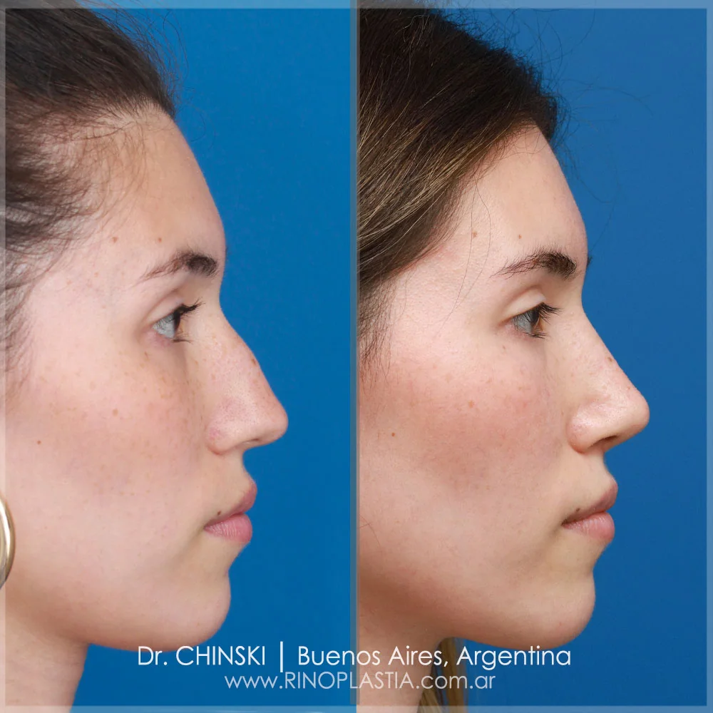 Antes e depois de rinoplastia – caso 98
