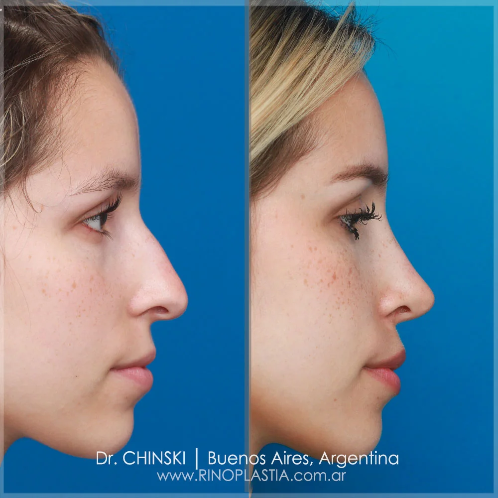 Antes e depois de rinoplastia – caso 99